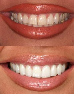 Veneers-before-and-after1